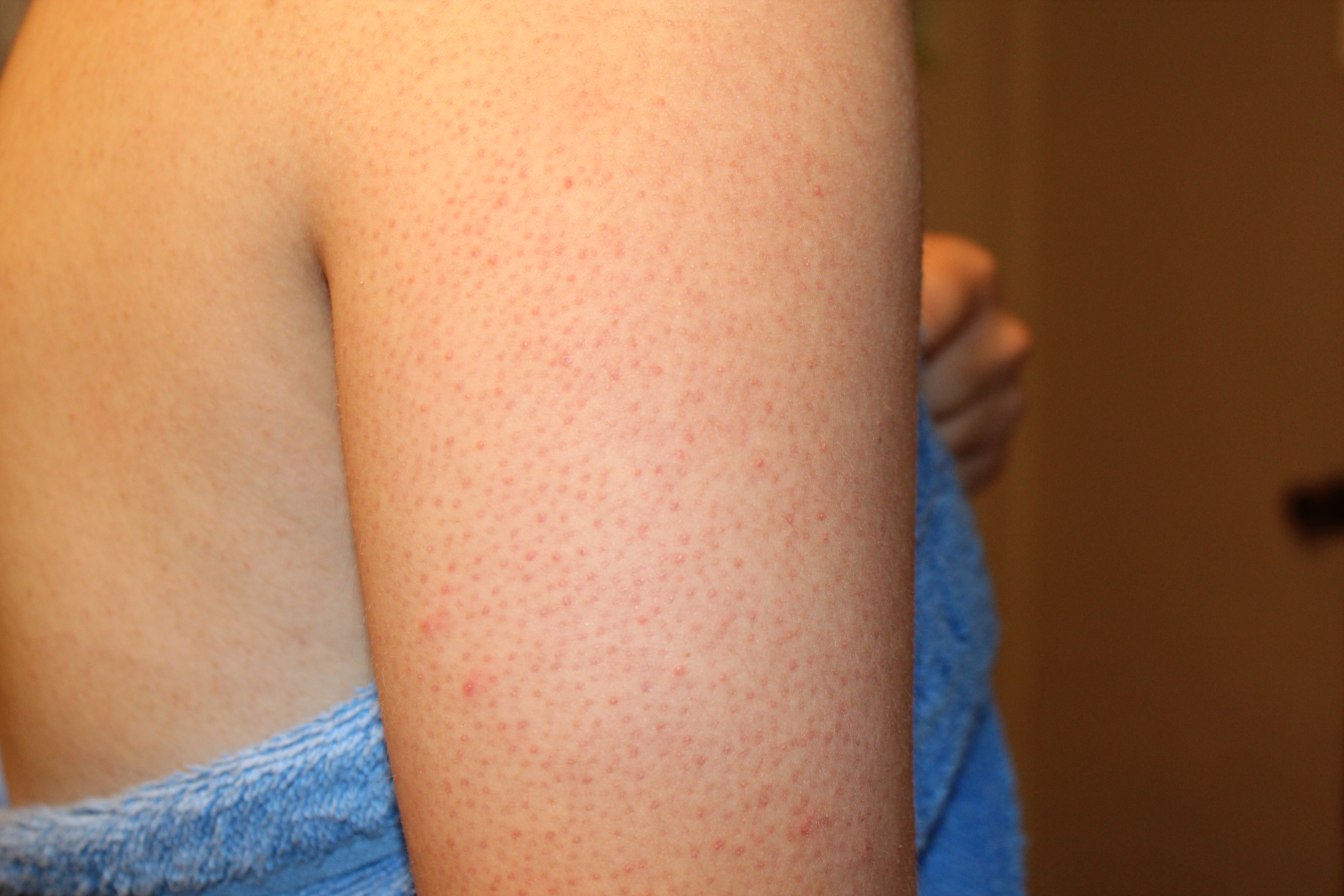  skin, sugar pimples, white arm bump things, or incorrectly diagnosed
